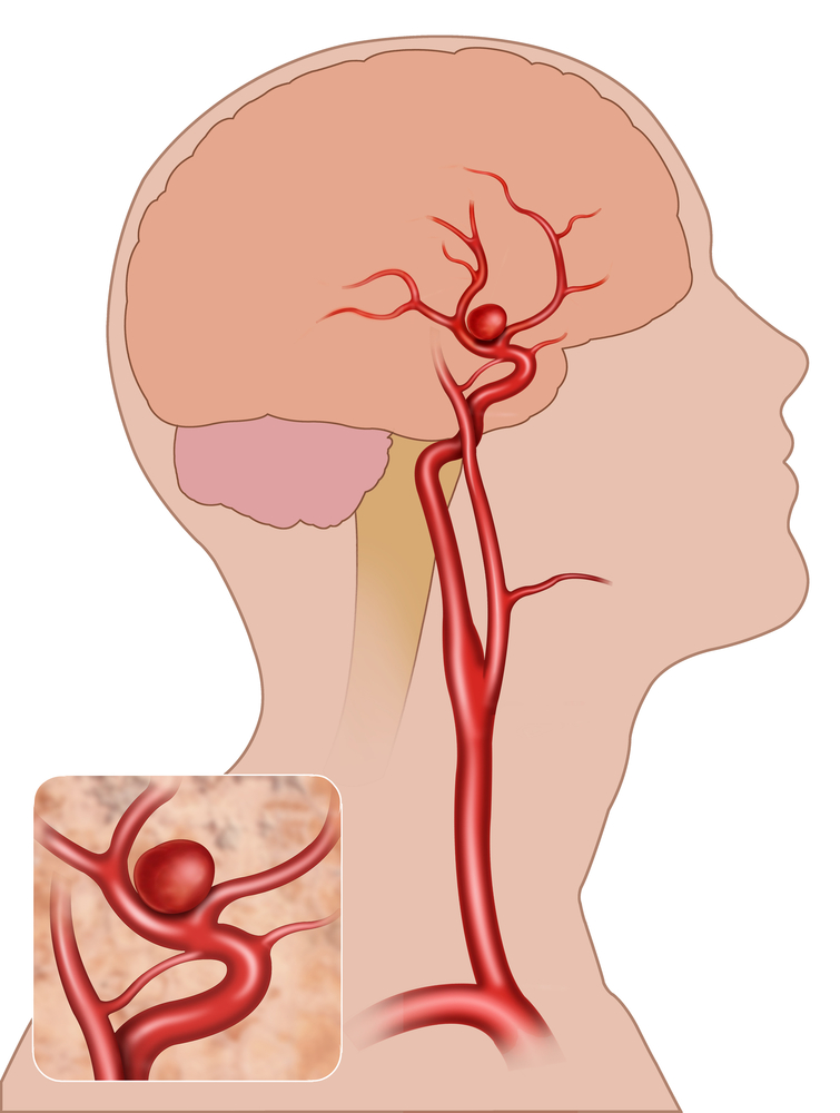 Aneurisma Cerebrale Quando A Rischio Rottura Ed Emorragia Cerebrale